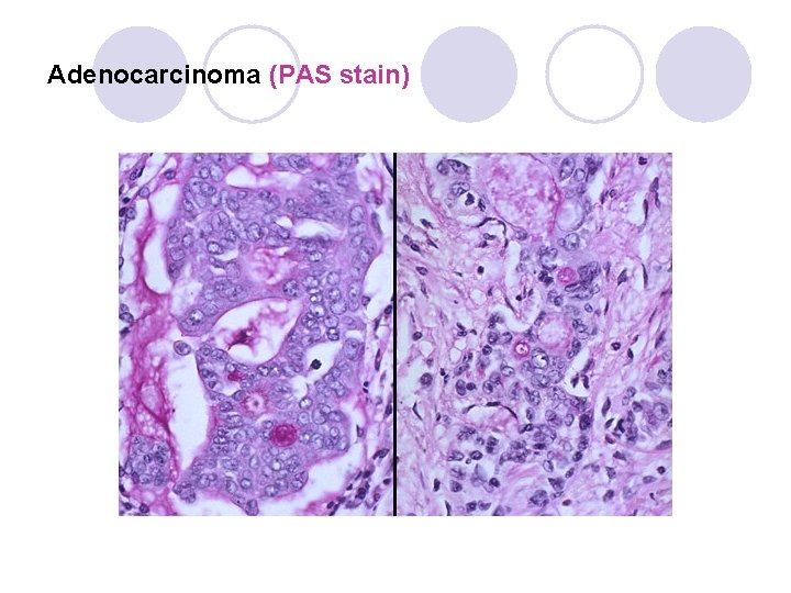 Adenocarcinoma (PAS stain) Adenocarcinoma (PAS stain)