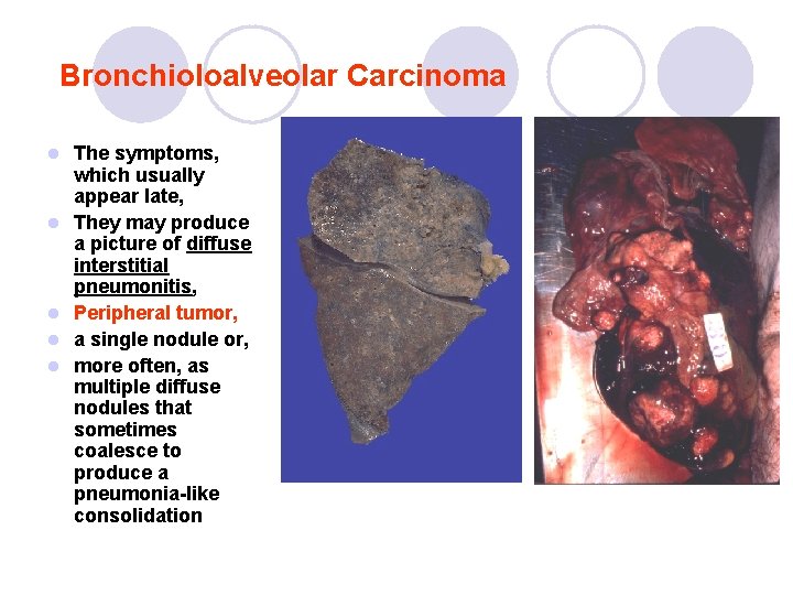 Bronchioloalveolar Carcinoma l l l The symptoms, which usually appear late, They may produce Bronchioloalveolar Carcinoma l l l The symptoms, which usually appear late, They may produce