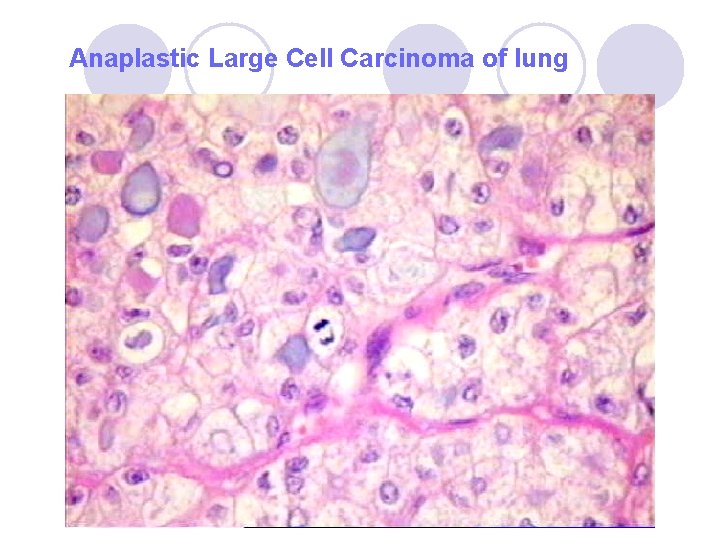 Anaplastic Large Cell Carcinoma of lung Anaplastic Large Cell Carcinoma of lung
