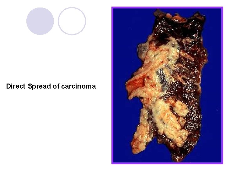 Direct Spread of carcinoma Direct Spread of carcinoma