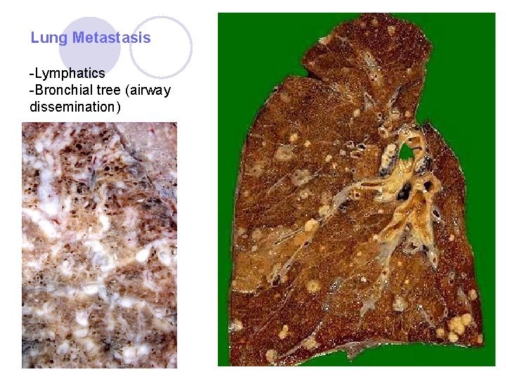 Lung Metastasis -Lymphatics -Bronchial tree (airway dissemination) Lung Metastasis -Lymphatics -Bronchial tree (airway dissemination)