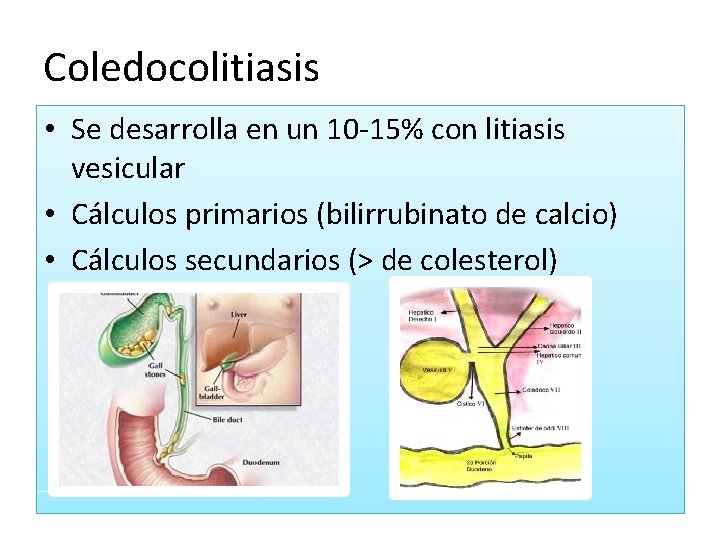 Coledocolitiasis • Se desarrolla en un 10 -15% con litiasis vesicular • Cálculos primarios Coledocolitiasis • Se desarrolla en un 10 -15% con litiasis vesicular • Cálculos primarios