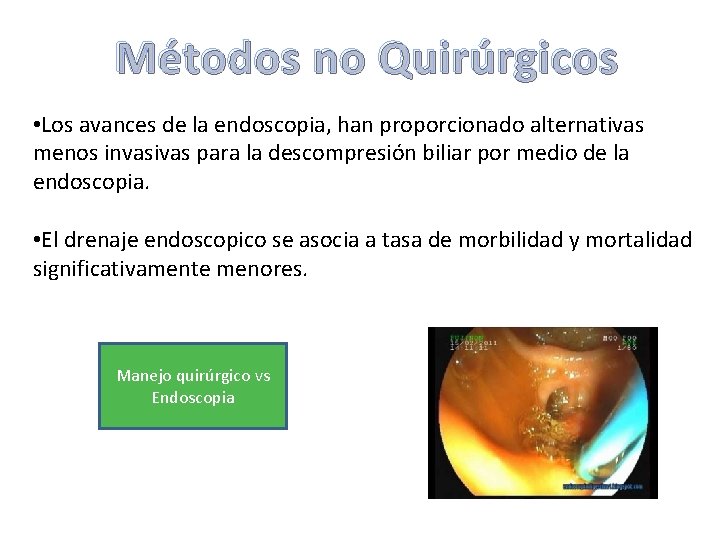 Métodos no Quirúrgicos • Los avances de la endoscopia, han proporcionado alternativas menos invasivas Métodos no Quirúrgicos • Los avances de la endoscopia, han proporcionado alternativas menos invasivas