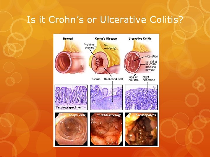 Is it Crohn’s or Ulcerative Colitis? 