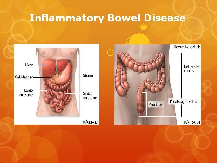 Inflammatory Bowel Disease 