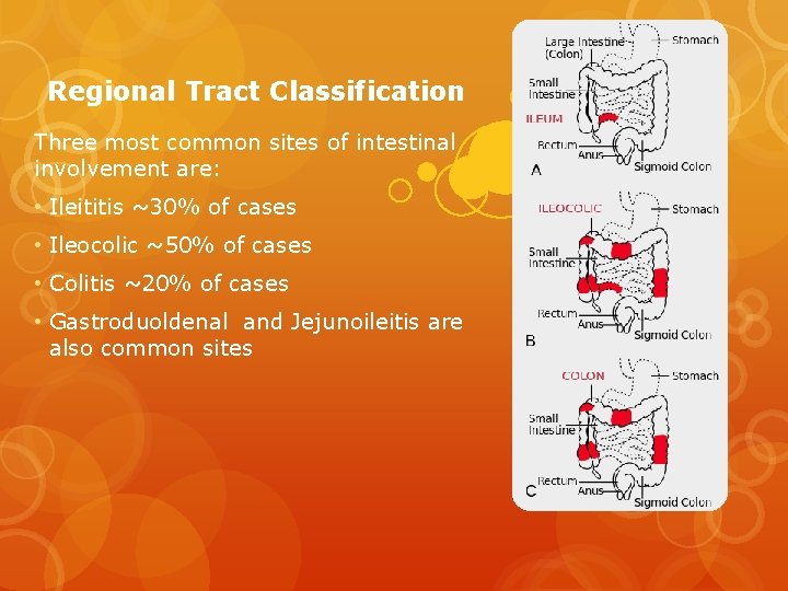 Regional Tract Classification Three most common sites of intestinal involvement are: • Ileititis ~30%