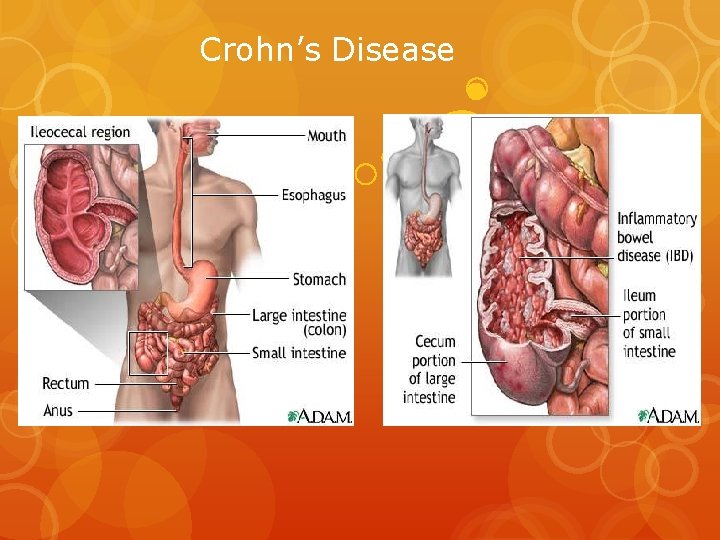 Crohn’s Disease 
