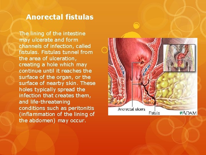 Anorectal fistulas The lining of the intestine may ulcerate and form channels of infection,