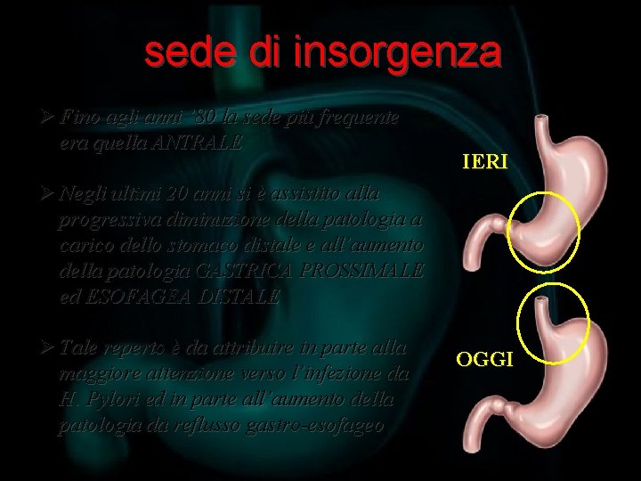sede di insorgenza Ø Fino agli anni ’ 80 la sede più frequente era