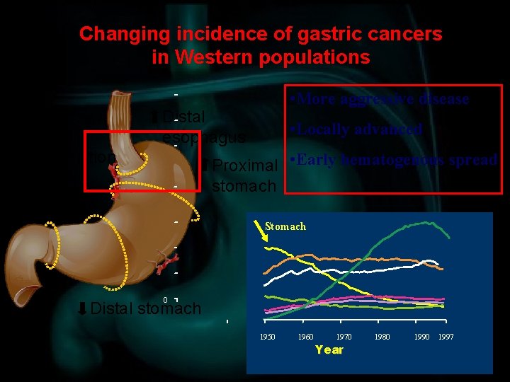 Changing incidence of gastric cancers in Western populations • More aggressive disease Distal esophagus
