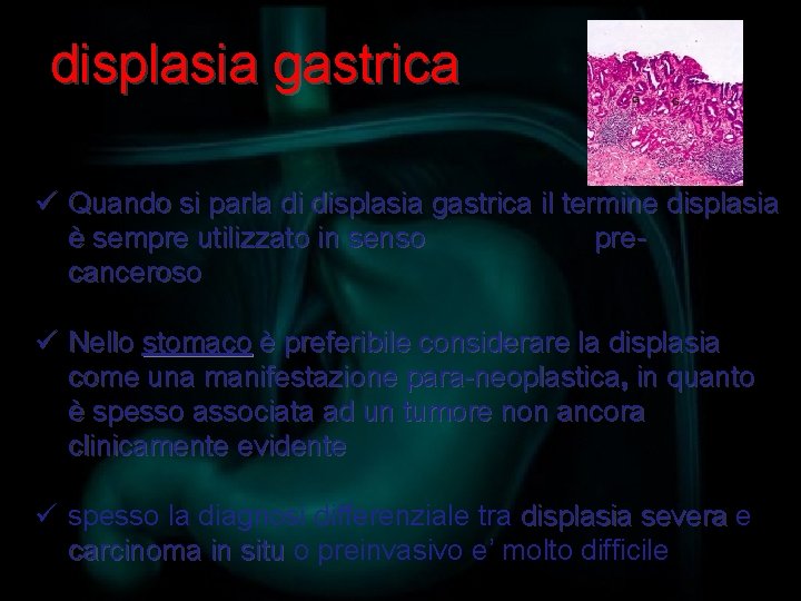 displasia gastrica ü Quando si parla di displasia gastrica il termine displasia è sempre