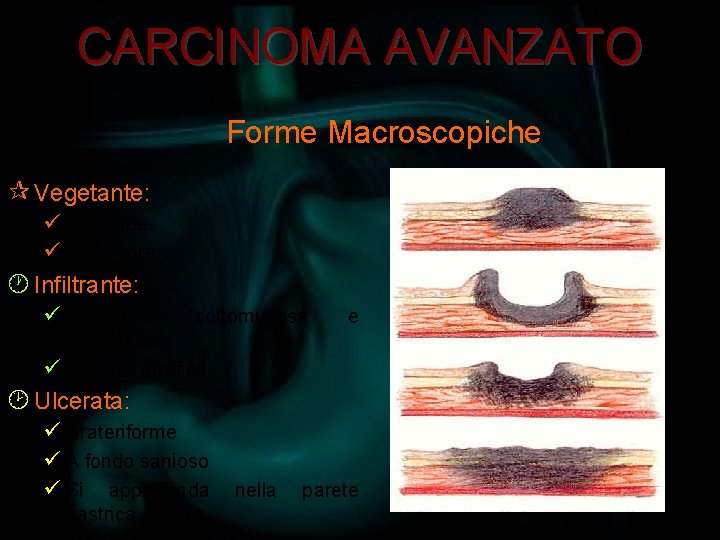 CARCINOMA AVANZATO Forme Macroscopiche ¶ Vegetante: ü Polipoide ü Cavolfiore · Infiltrante: ü Diffusione
