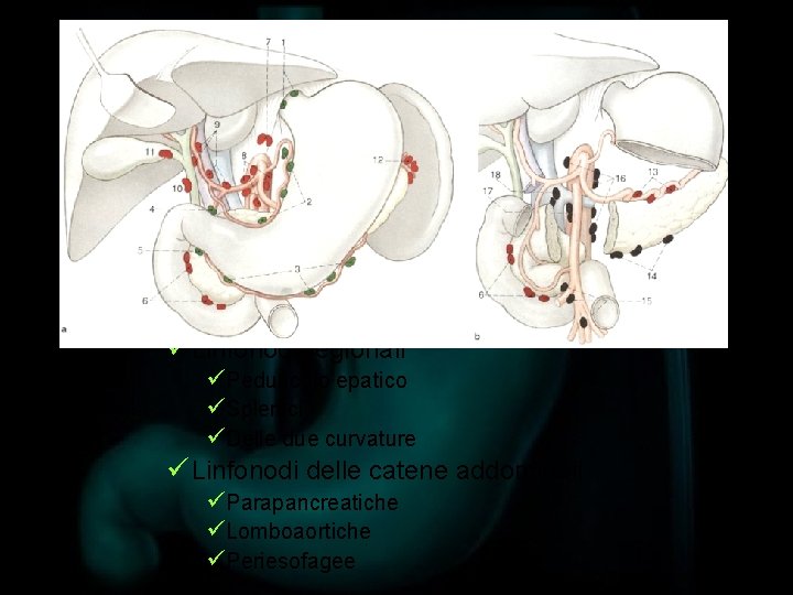 Carcinoma gastrico avanzato Vie di Diffusione ëPer contiguità: ü Molto precoce ü A organi