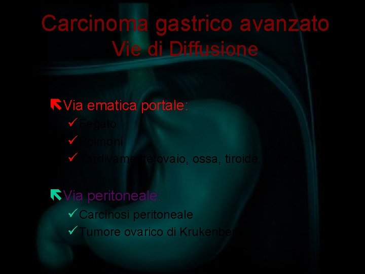 Carcinoma gastrico avanzato Vie di Diffusione ëVia ematica portale: ü Fegato ü Polmoni ü