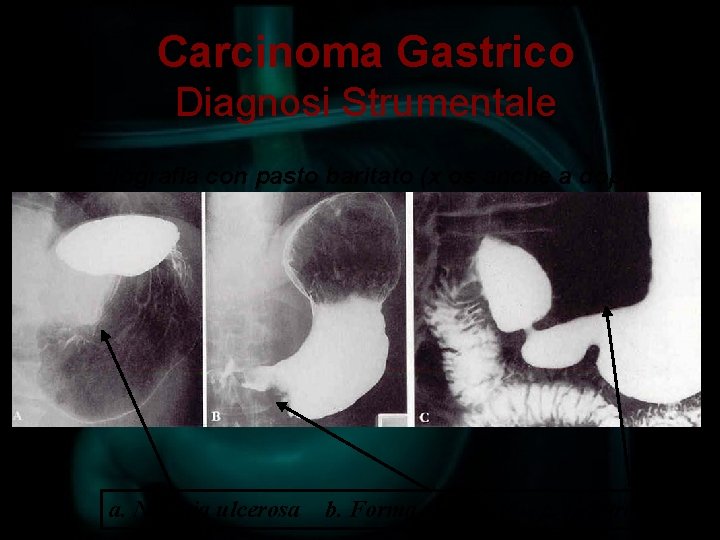 Carcinoma Gastrico Diagnosi Strumentale Radiografia con pasto baritato (x os anche a doppio contrasto)
