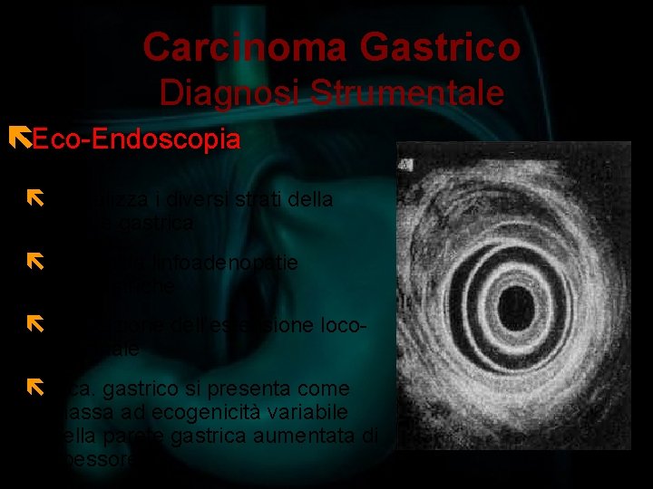 Carcinoma Gastrico Diagnosi Strumentale ëEco-Endoscopia ë Visualizza i diversi strati della parete gastrica ë