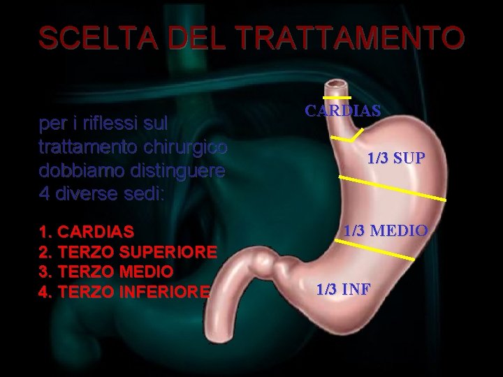SCELTA DEL TRATTAMENTO per i riflessi sul trattamento chirurgico dobbiamo distinguere 4 diverse sedi: