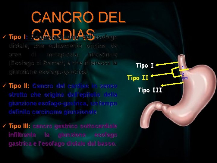 CANCRO DEL ü Tipo I: Adenocarcinoma dell’esofago CARDIAS distale, che solitamente origina da aree