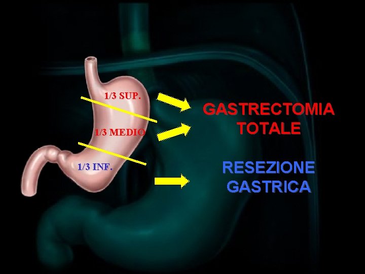 1/3 SUP. 1/3 MEDIO 1/3 INF. GASTRECTOMIA TOTALE RESEZIONE GASTRICA 