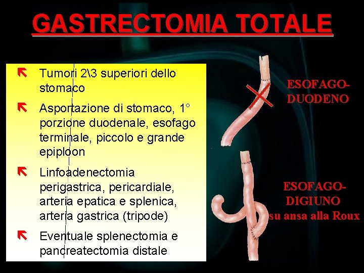 GASTRECTOMIA TOTALE ë Tumori 23 superiori dello stomaco ë Asportazione di stomaco, 1° ESOFAGODUODENO
