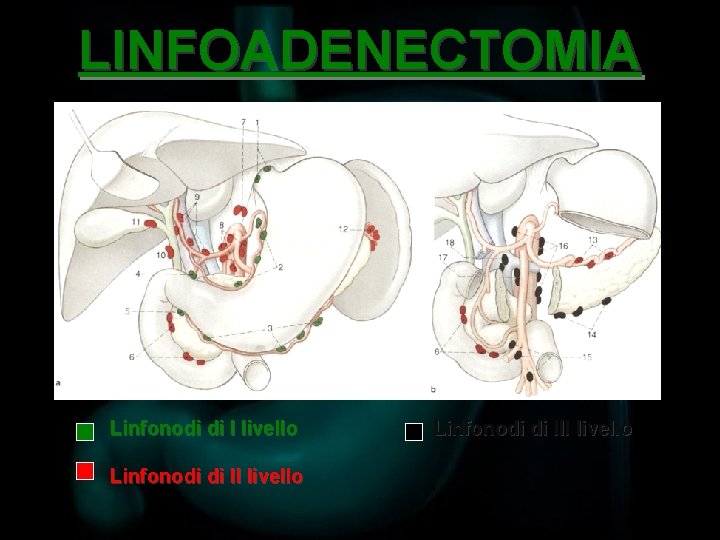 LINFOADENECTOMIA Linfonodi di I livello Linfonodi di III livello 