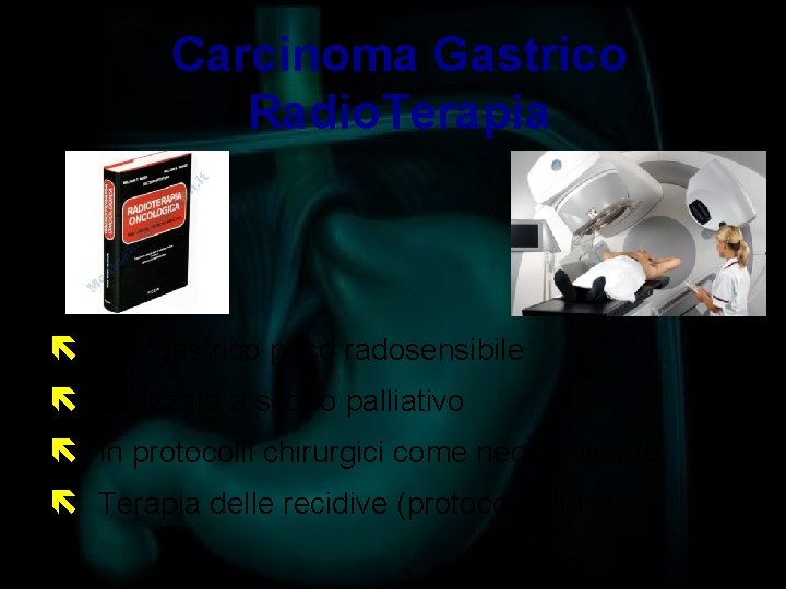 Carcinoma Gastrico Radio. Terapia ë Ca. gastrico poco radosensibile ë Utilizzata a scopo palliativo