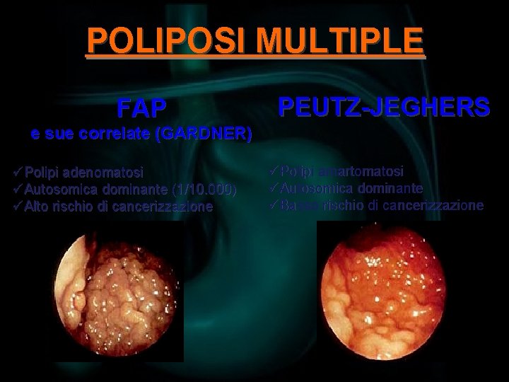 POLIPOSI MULTIPLE FAP PEUTZ-JEGHERS e sue correlate (GARDNER) üPolipi adenomatosi üAutosomica dominante (1/10. 000)