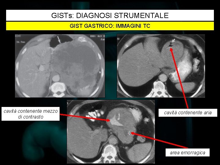 GISTs: DIAGNOSI STRUMENTALE GIST GASTRICO: IMMAGINI TC cavità contenente mezzo di contrasto cavità contenente
