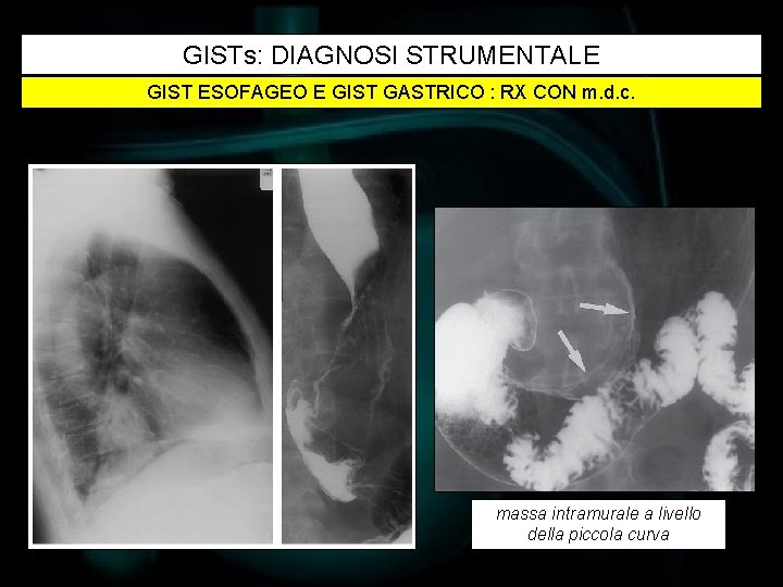 GISTs: DIAGNOSI STRUMENTALE GIST ESOFAGEO E GIST GASTRICO : RX CON m. d. c.