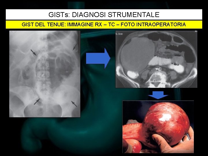 GISTs: DIAGNOSI STRUMENTALE GIST DEL TENUE: IMMAGINE RX – TC – FOTO INTRAOPERATORIA 