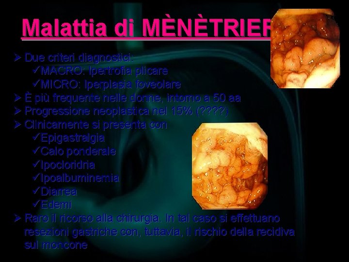 Malattia di MÈNÈTRIER Ø Due criteri diagnostici: üMACRO: Ipertrofia plicare üMICRO: Iperplasia foveolare Ø
