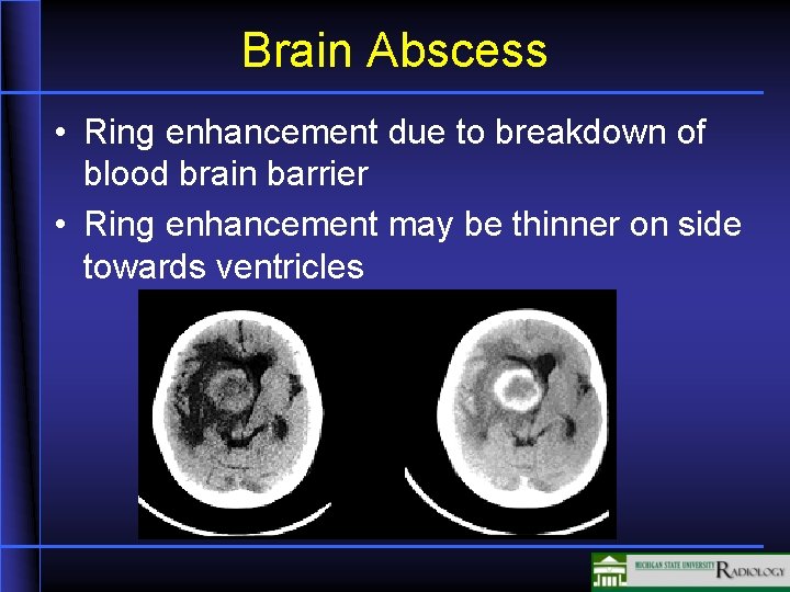 Brain Abscess • Ring enhancement due to breakdown of blood brain barrier • Ring