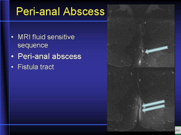 Peri-anal Abscess • MRI fluid sensitive sequence • Peri-anal abscess • Fistula tract 