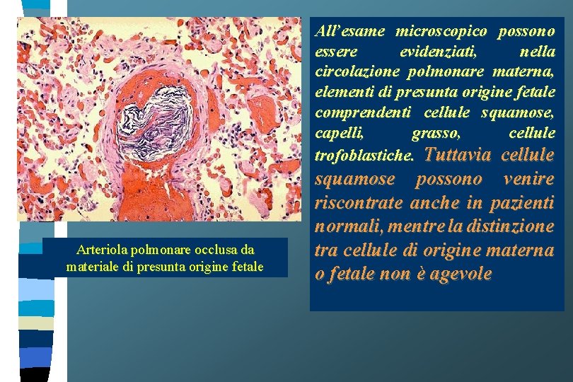All’esame microscopico possono essere evidenziati, nella circolazione polmonare materna, elementi di presunta origine fetale