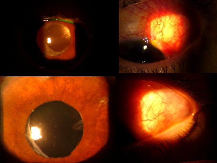 CASO CLÍNICO SECCIÓN GLAUCOMA: • Gonioscopia: Grado IV + Sangre en Schlemm • 2014