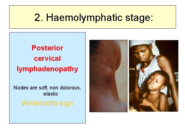 2. Haemolymphatic stage: Posterior cervical lymphadenopathy Nodes are soft, non dolorous, elastic Winterbotts sign