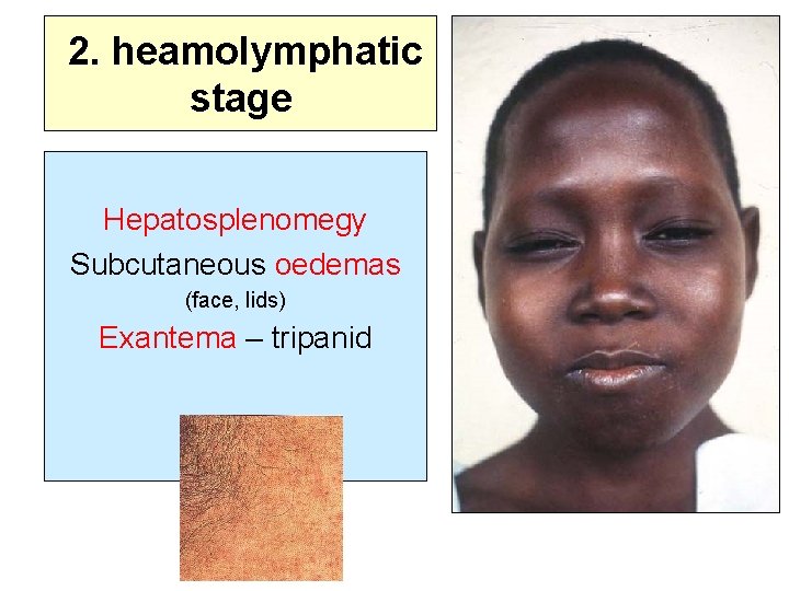 2. heamolymphatic stage Hepatosplenomegy Subcutaneous oedemas (face, lids) Exantema – tripanid 