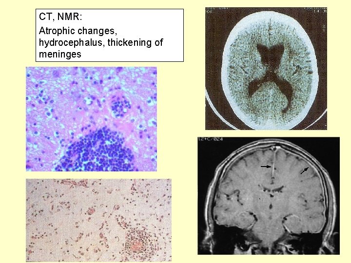 CT, NMR: Atrophic changes, hydrocephalus, thickening of meninges 