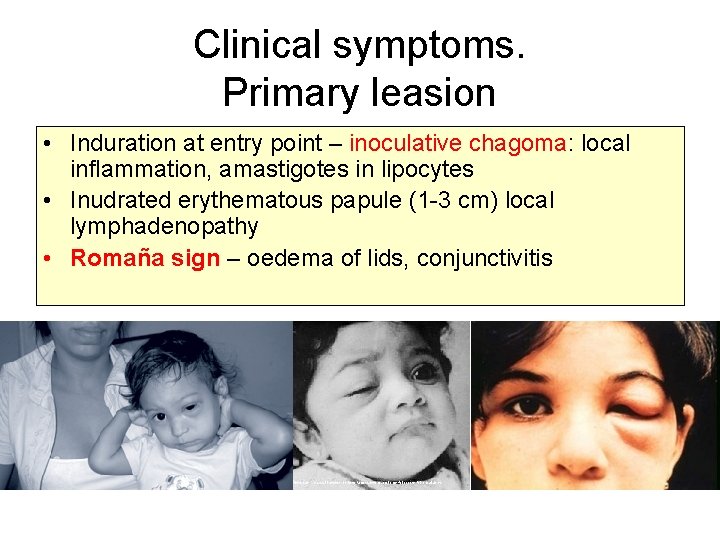 Clinical symptoms. Primary leasion • Induration at entry point – inoculative chagoma: local inflammation,