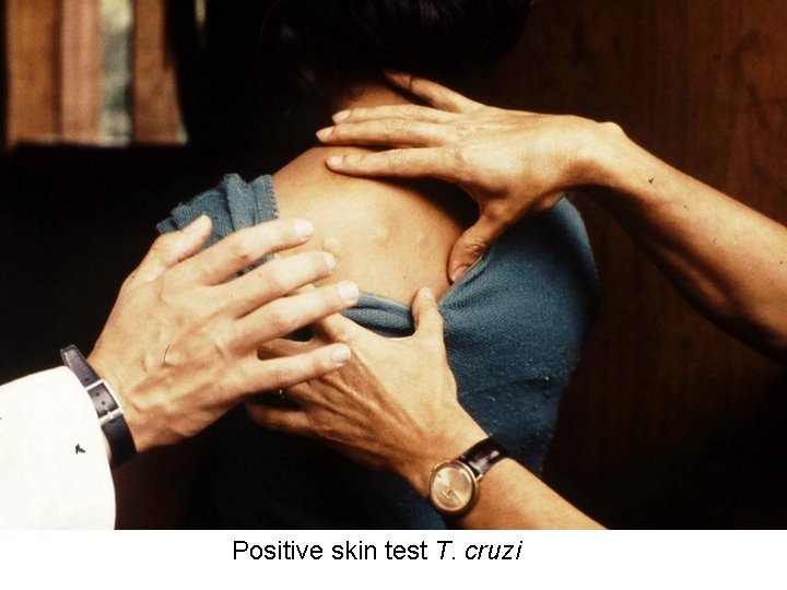 Positive skin test T. cruzi 