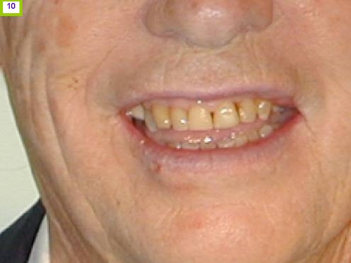 10 2. Estética gingival: Línea de sonrisa: Importancia en terminación cervical. J. I. H.