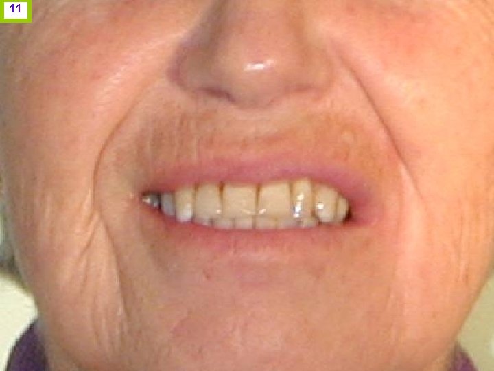 11 2. Estética gingival: Línea de sonrisa: Importancia en terminación cervical. J. I. H.