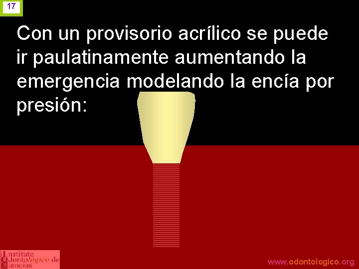 17 Con un provisorio acrílico se puede ir paulatinamente aumentando la emergencia modelando la