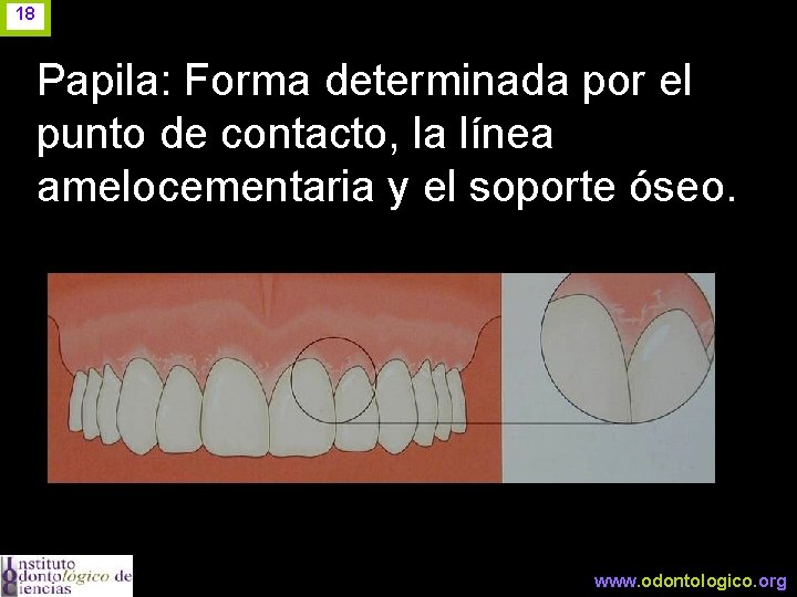 18 Papila: Forma determinada por el punto de contacto, la línea amelocementaria y el