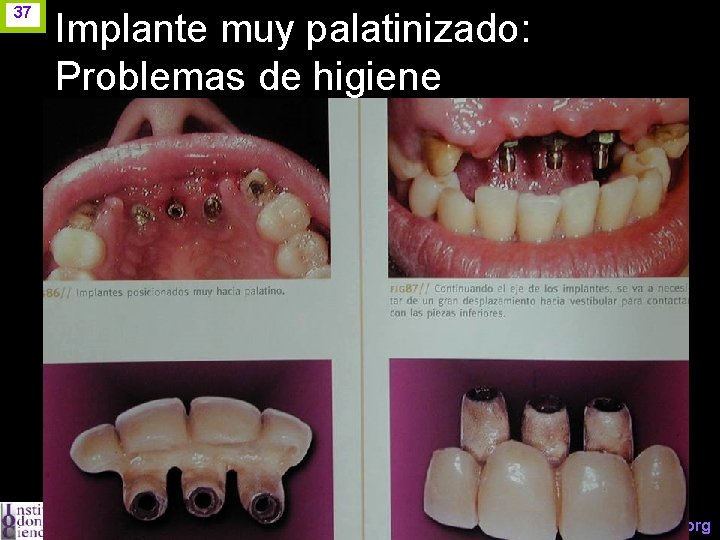 37 Implante muy palatinizado: Problemas de higiene www. odontologico. org 
