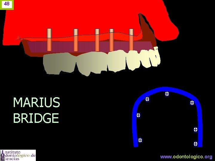 48 MARIUS BRIDGE www. odontologico. org 