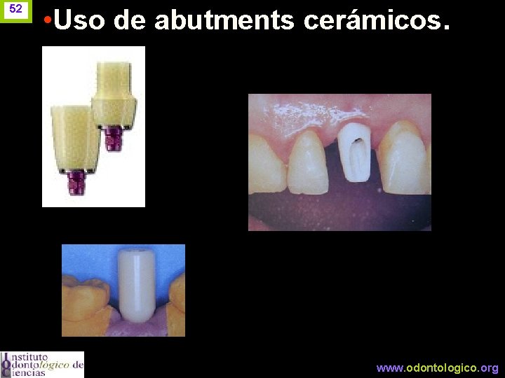 52 • Uso de abutments cerámicos. www. odontologico. org 