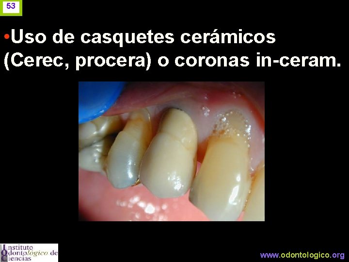 53 • Uso de casquetes cerámicos (Cerec, procera) o coronas in-ceram. www. odontologico. org