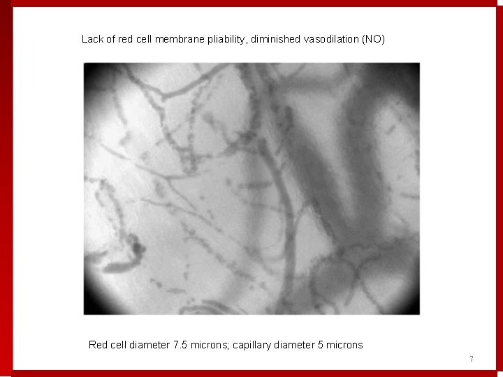Lack of red cell membrane pliability, diminished vasodilation (NO) Red cell diameter 7. 5