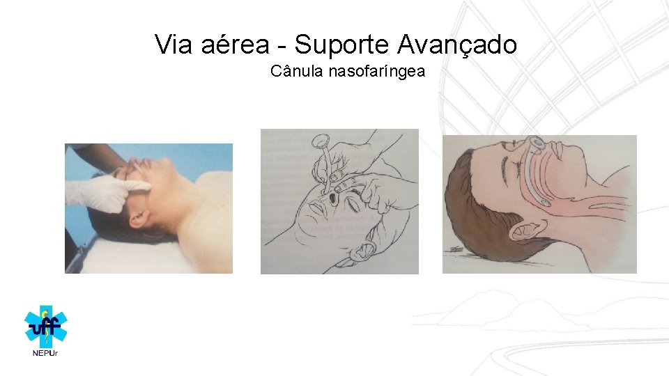 Via aérea - Suporte Avançado Cânula nasofaríngea 